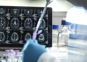 Έρχεται και στην Ελλάδα το νέο φάρμακο για το Αλτσχάιμερ
